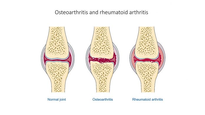 Arthritis pain