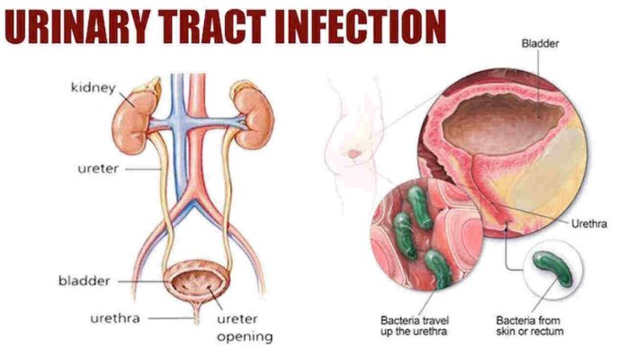 Urinary Tract Infection