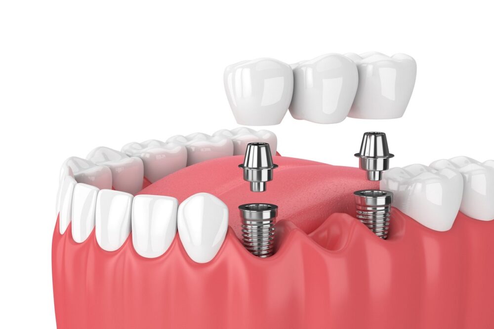 tooth implants in Los Angeles