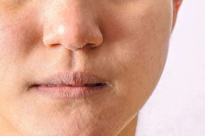 Eczema on Lips