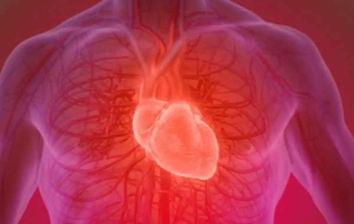 New AI model detects plaque erosion in arteries