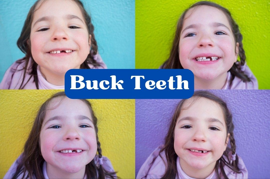 Buck Teeth