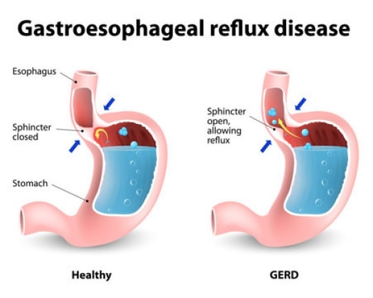 gastroesophageal reflux disease