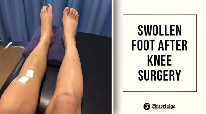 Swollen foot after knee surgery