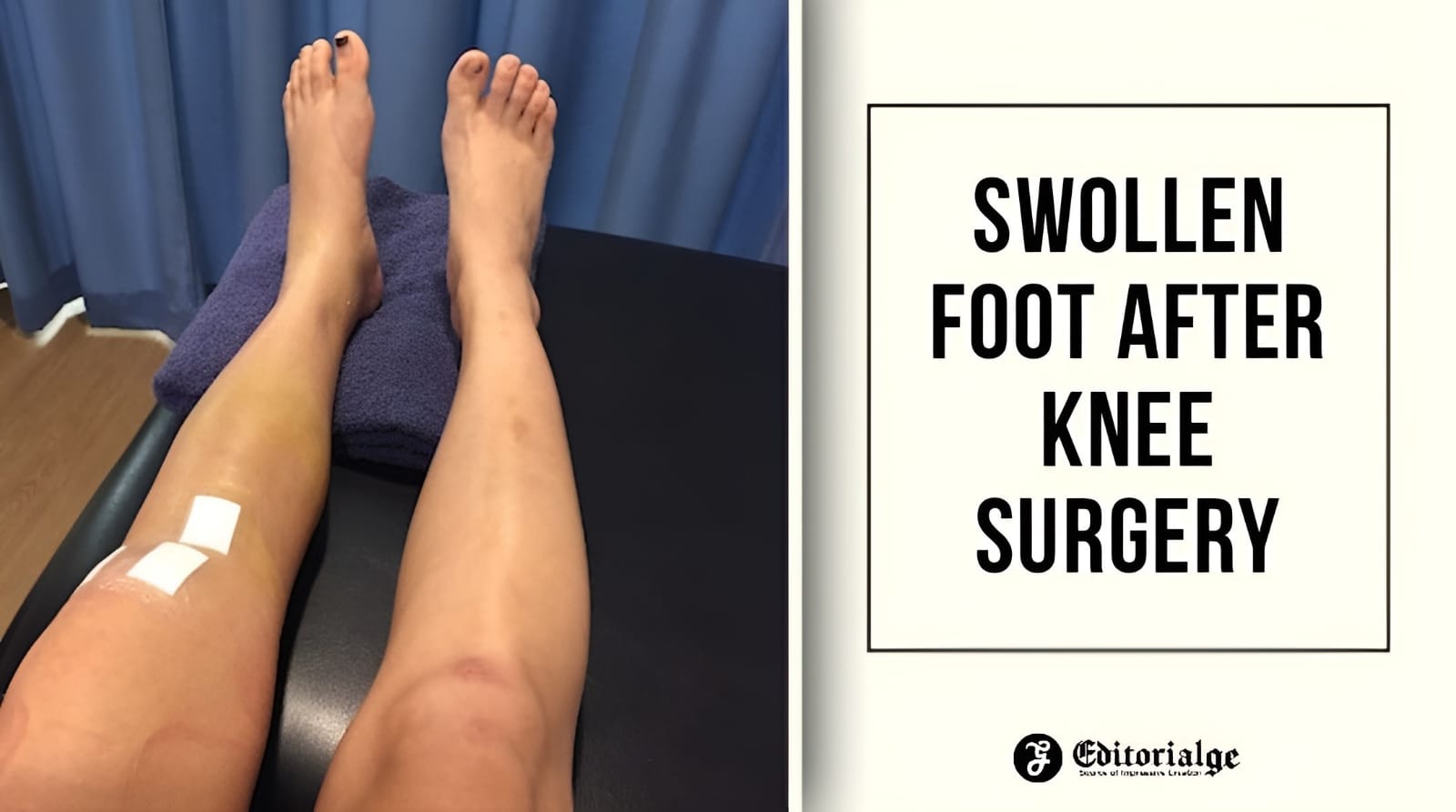 Swollen foot after knee surgery
