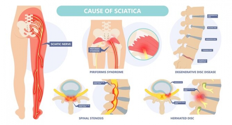 causes of sciatica