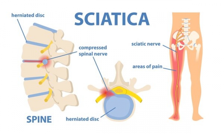 sciatica nerve pain