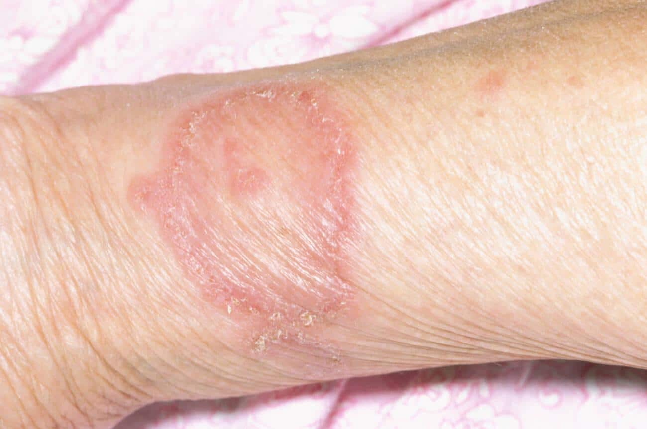 Erythema Annulare Centrifugum