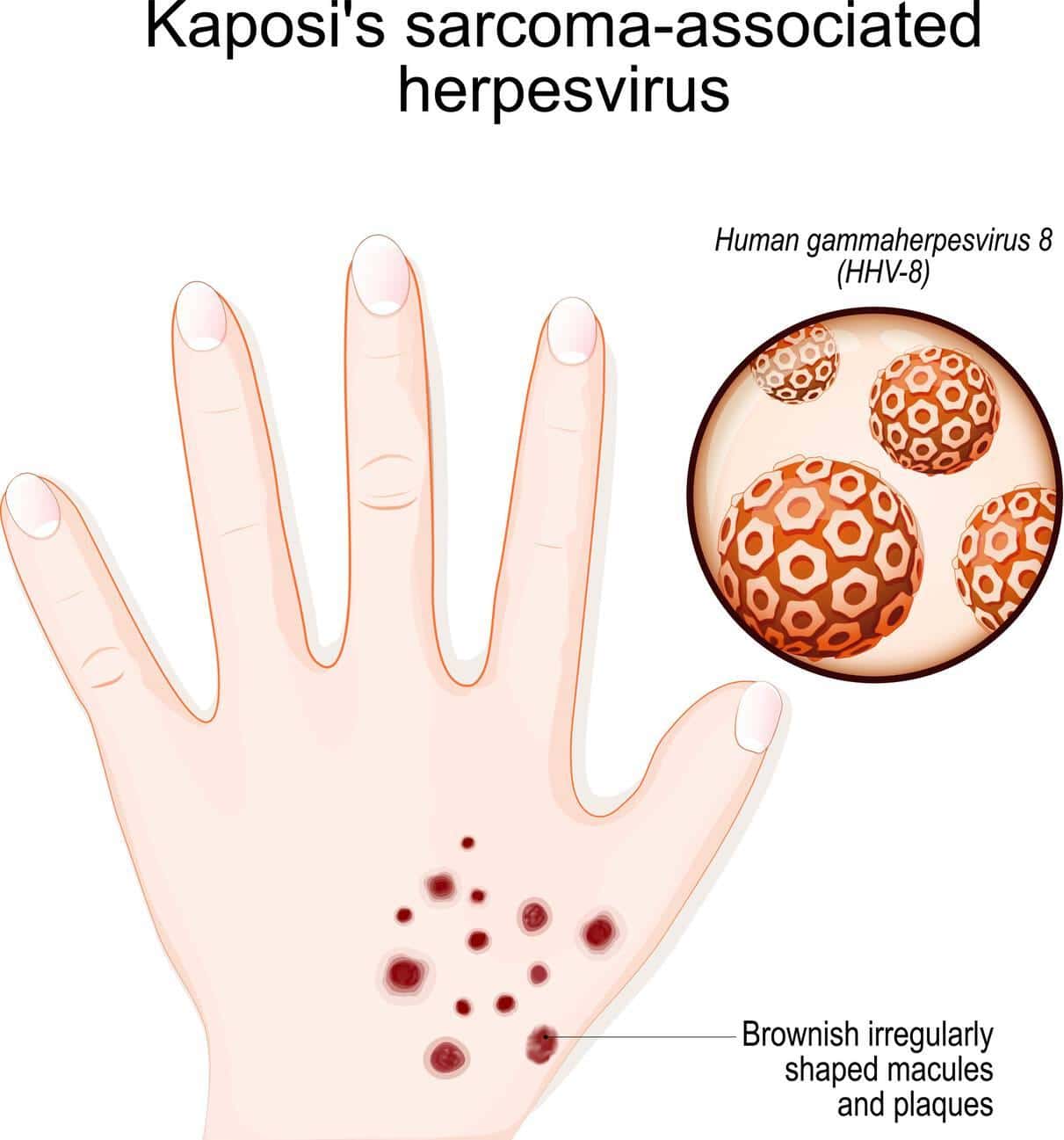 Kaposi's Sarcoma