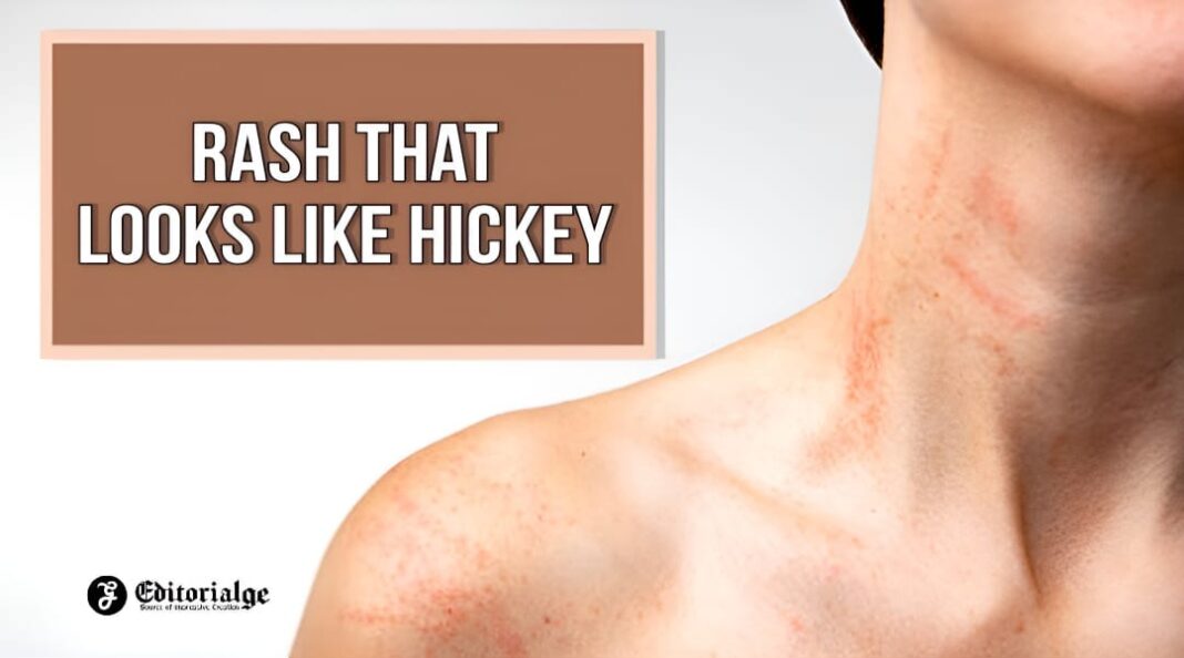 Uncovering the Mystery of Rash that Looks Like Hickey | Editorialge