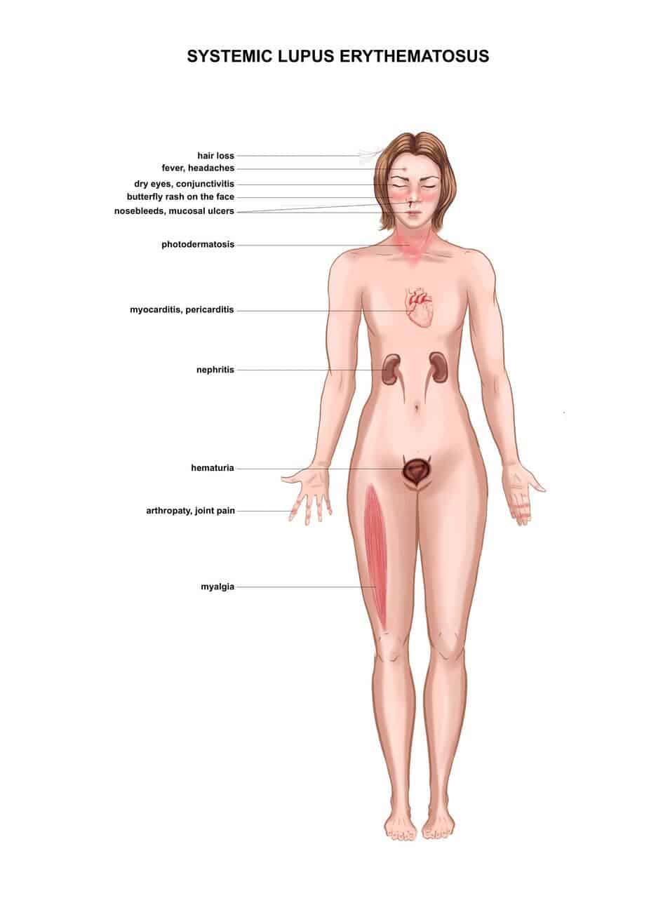 Systemic Lupus Erythematosus