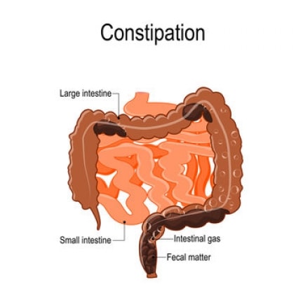 constipation