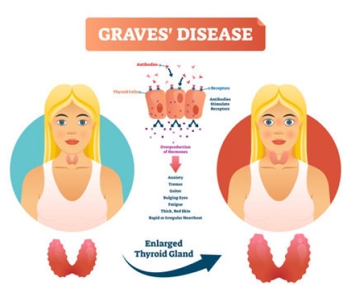 graves disease