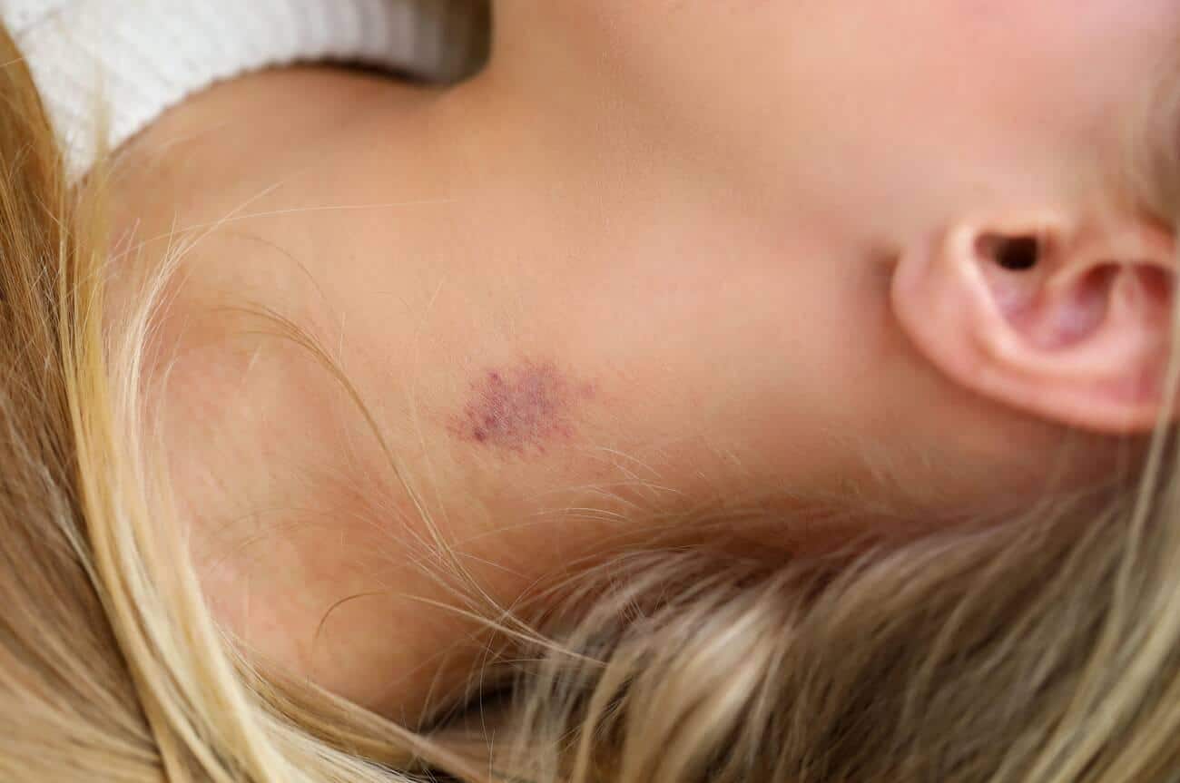 Uncovering the Mystery of Rash that Looks Like Hickey