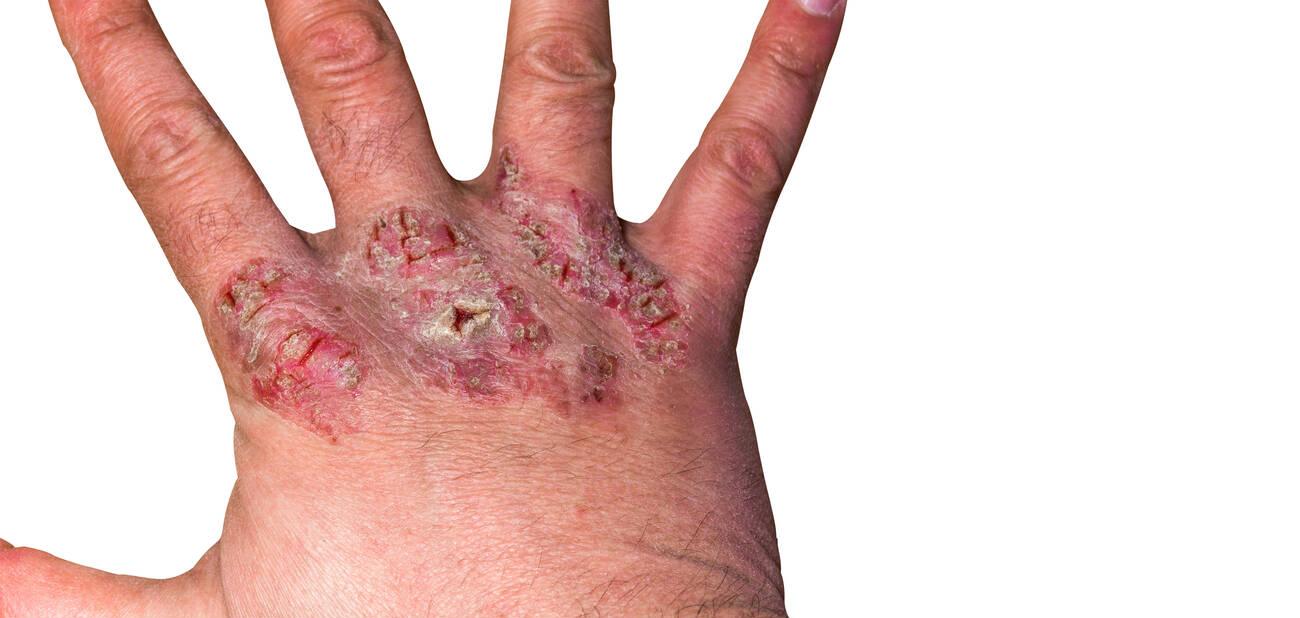 isolated psoriasis