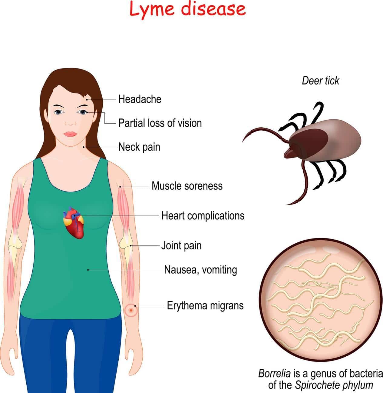 lyme disease