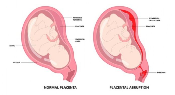 Subchorionic Infarct 8 Types of Healthy Foods to Heal Subchorionic Hemorrhage