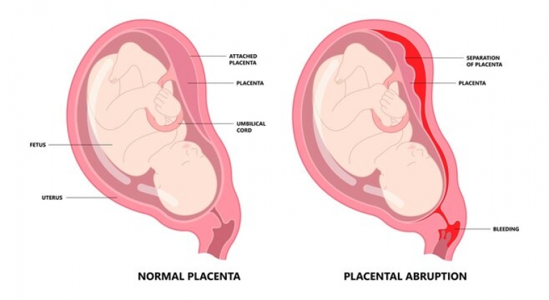 normal and abruption placental