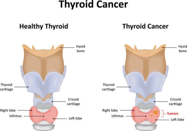 thyroid cancer