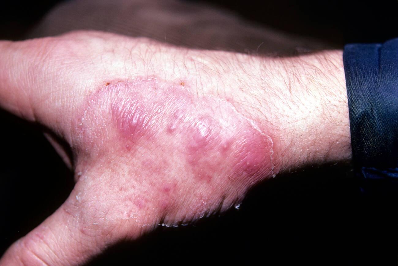 tinea rash