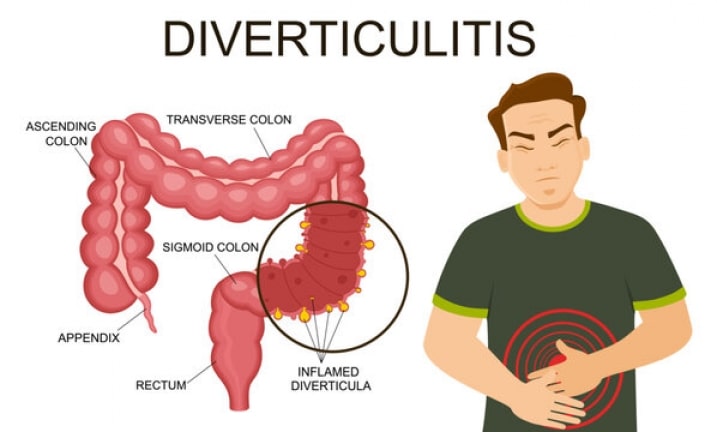 diverticulitis