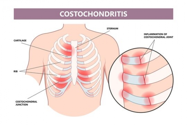 Costochondritis