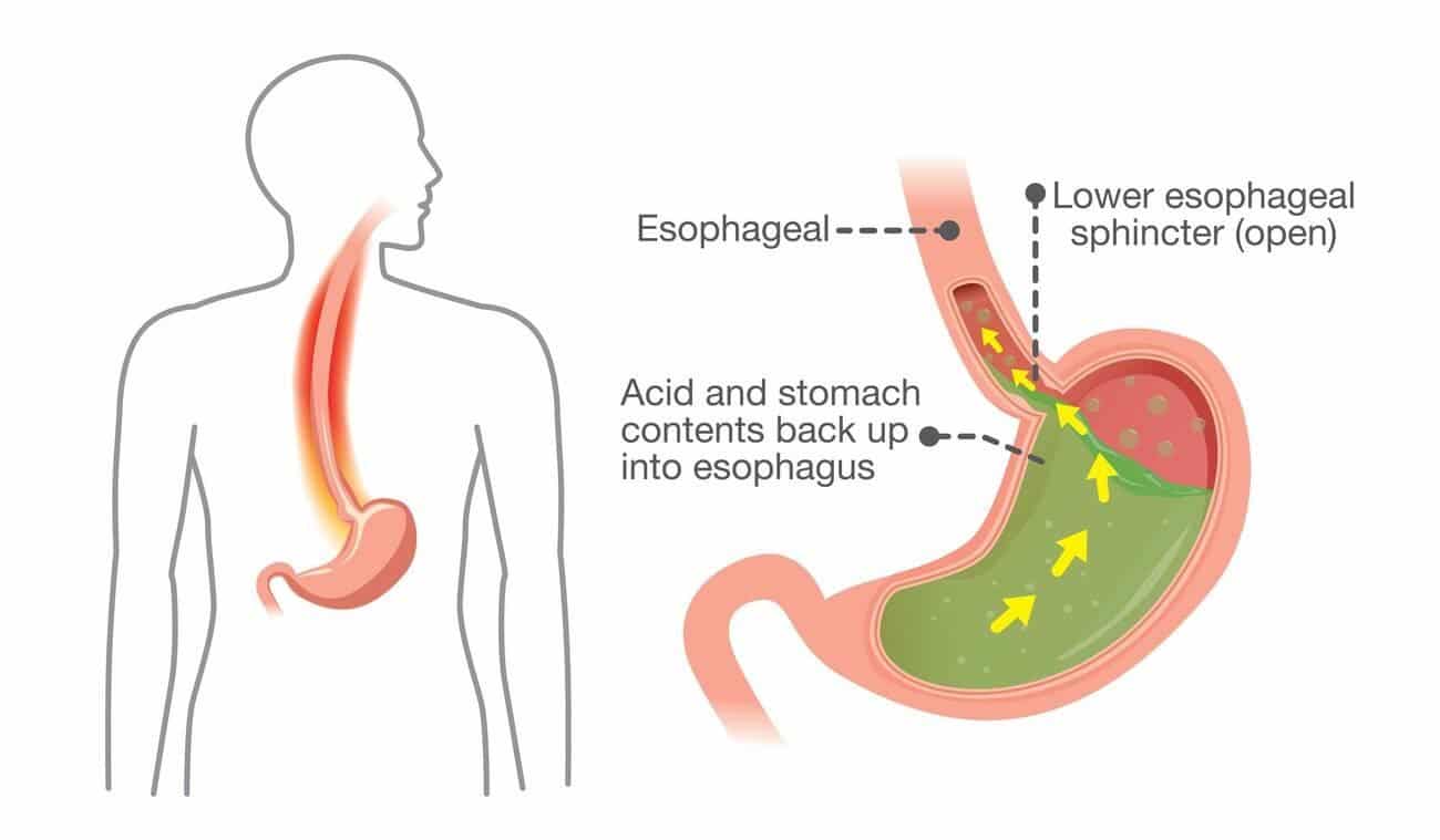 acid reflux formation