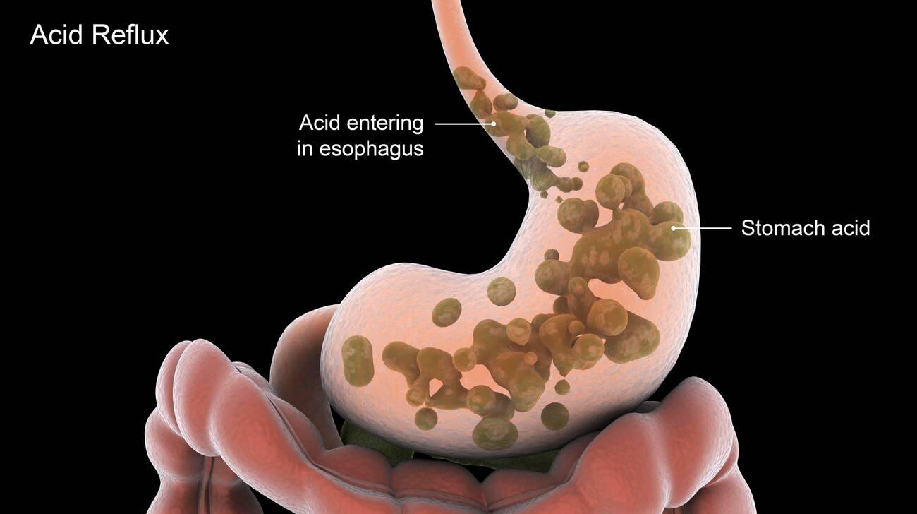 acid reflux