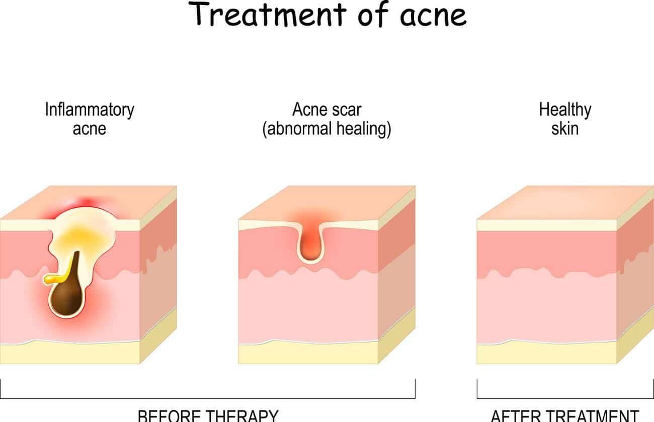 inflammatory acne