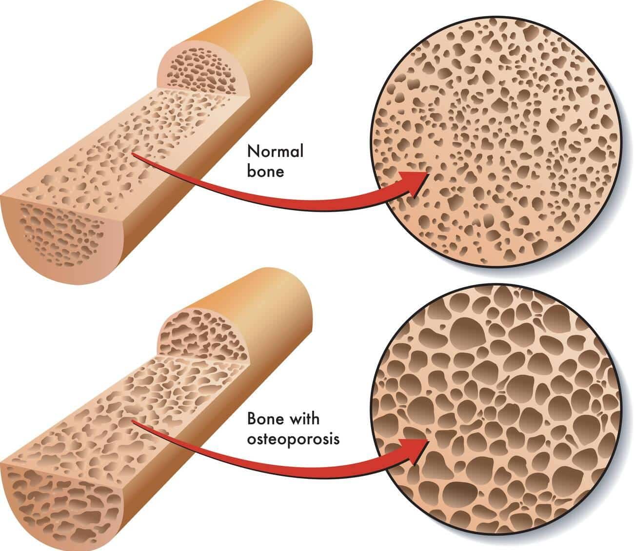 osteoporosis