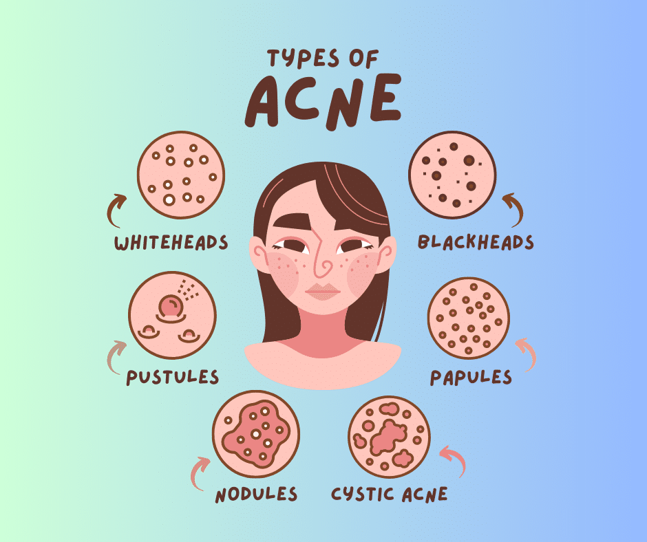 types of acne