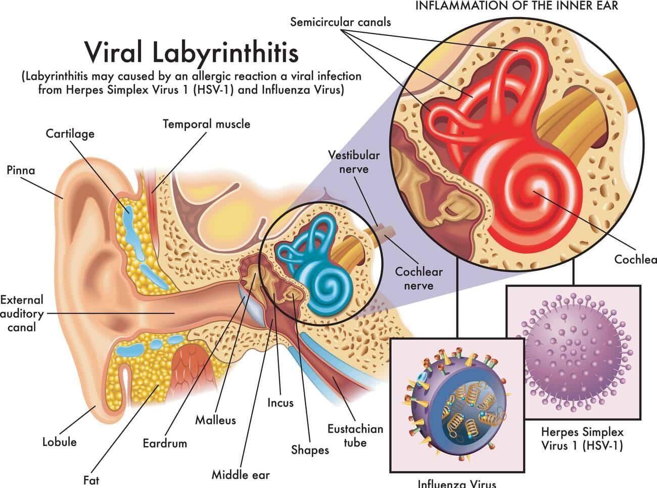 Labyrinthitis