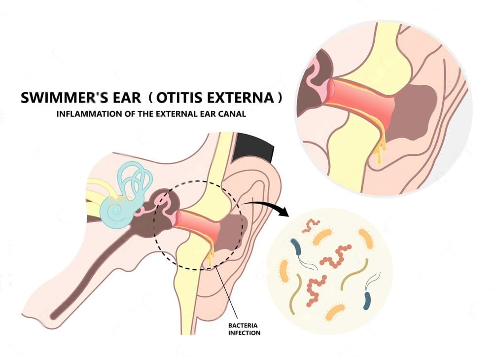 swimmer's ear 