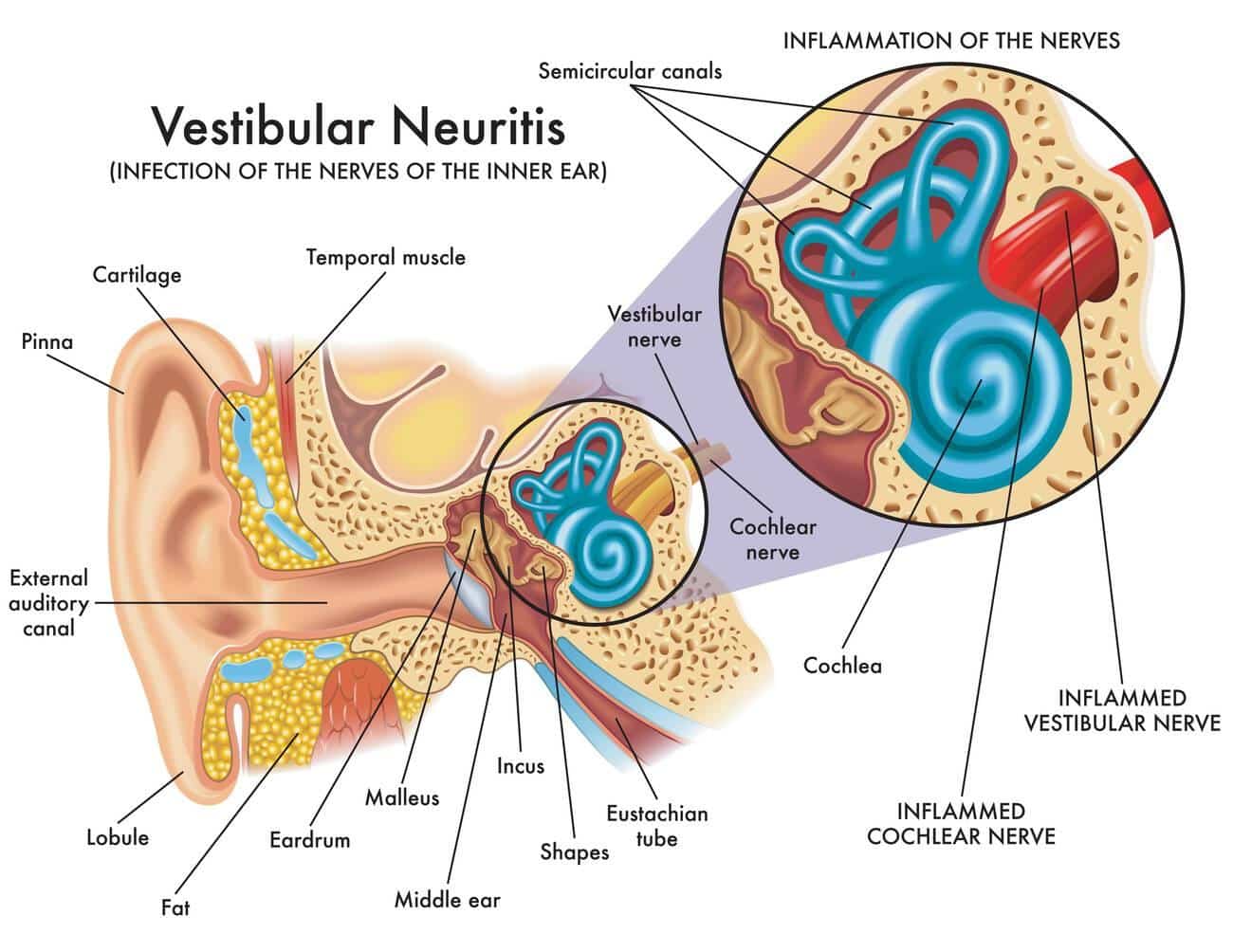 Are Ear Infections Contagious? 10 Rare Types of Ear Infections