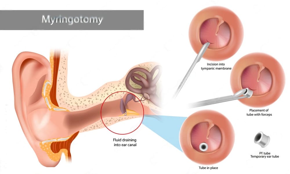 fluid in the ear