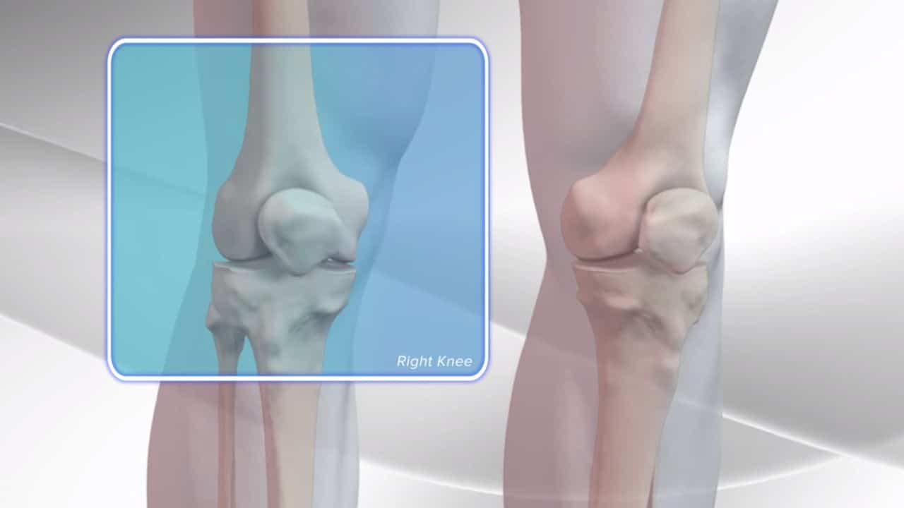 Knee Replacement Surgery Recovery Tips