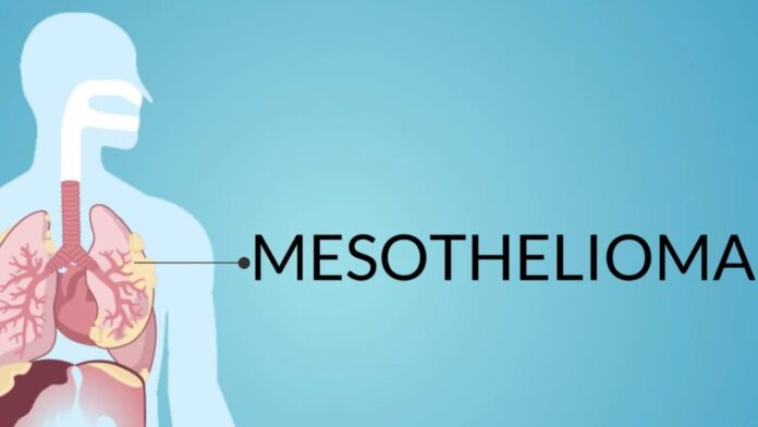 Managing mesothelioma symptoms