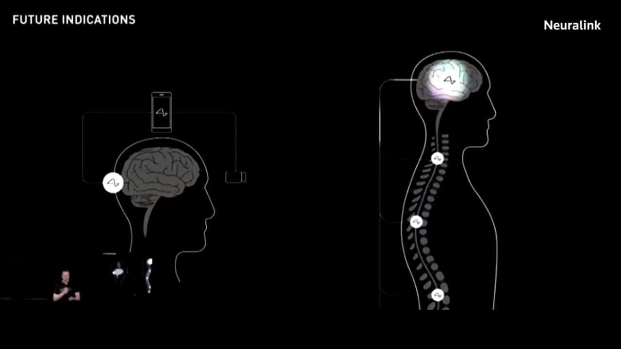 Neuralink Brain Implant Trial