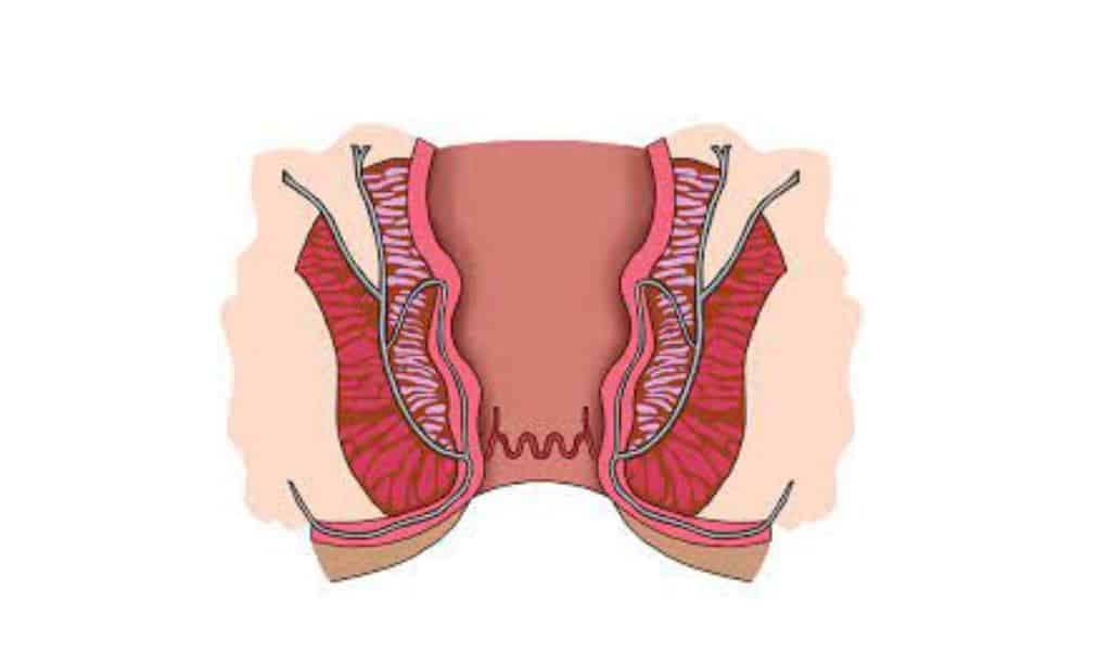 Proctalgia Fugax