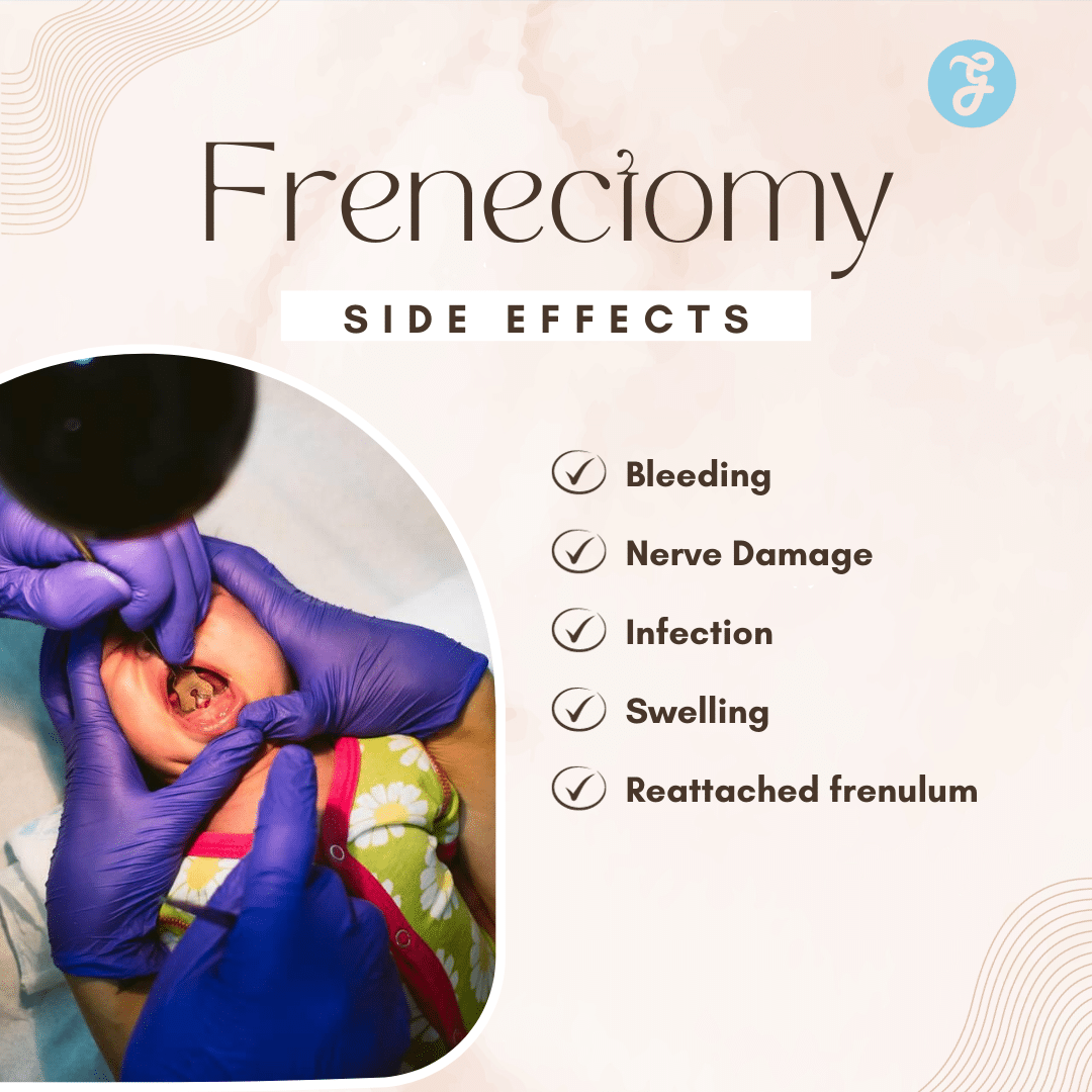 side effects of frenectomy