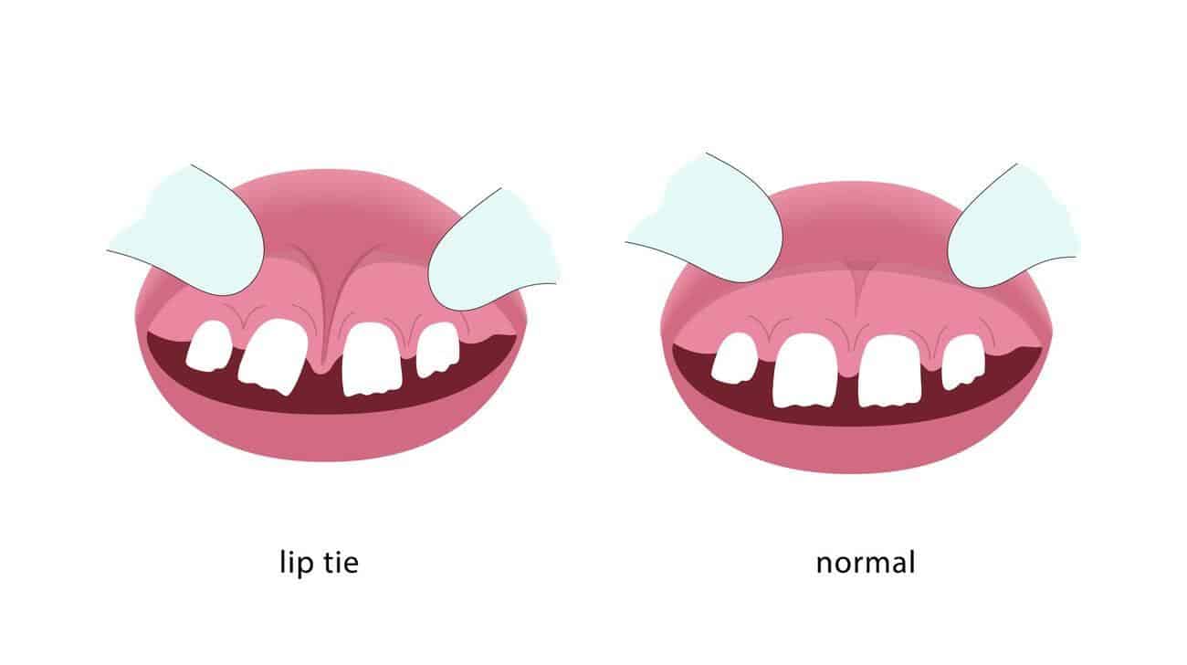 Lip Tie in Adults: 3 Best Treatment Options With Possible Symptoms