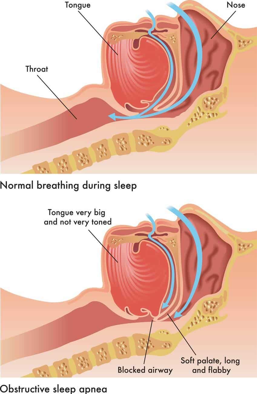 sleep apnea