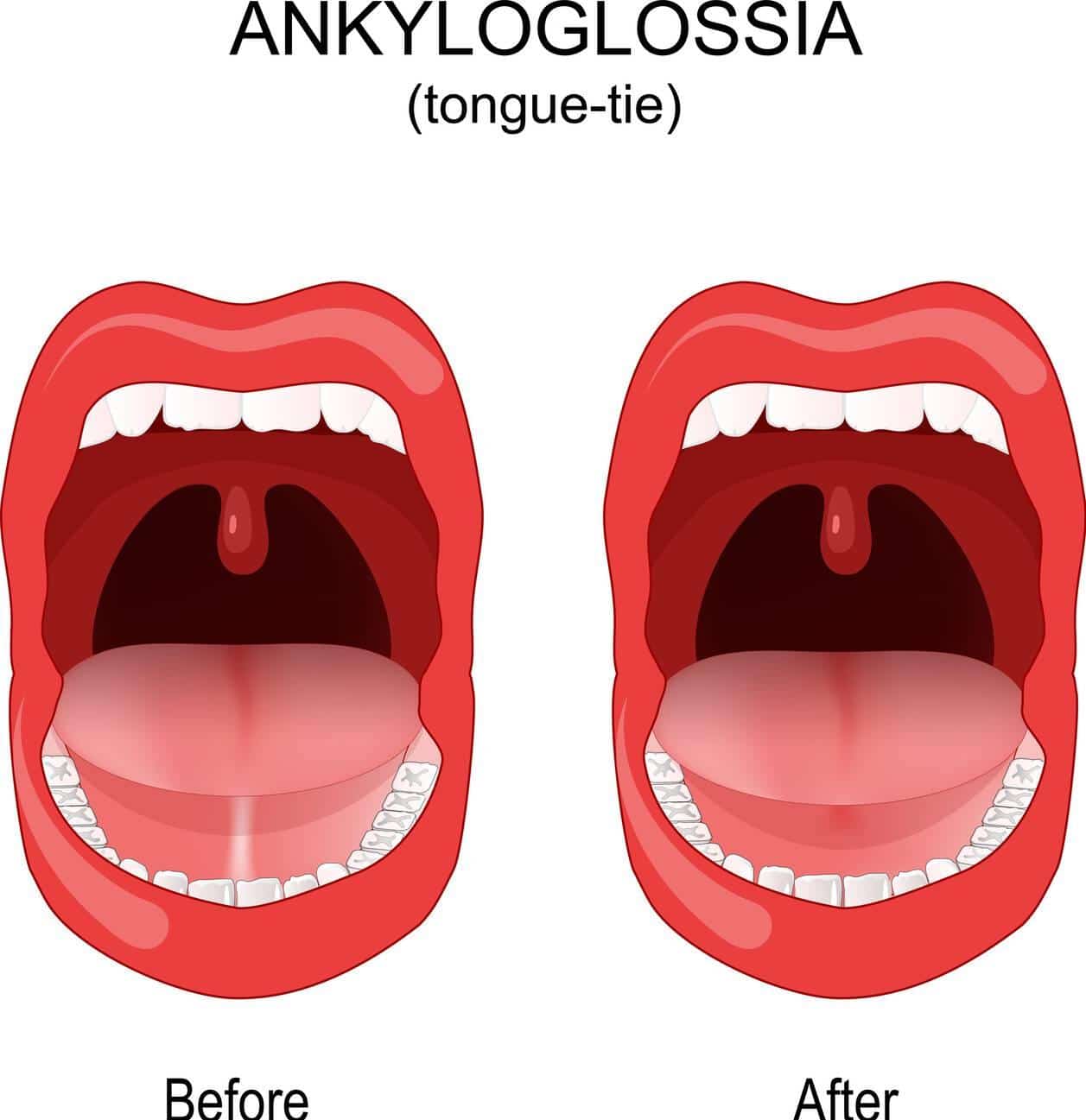 tongue tie