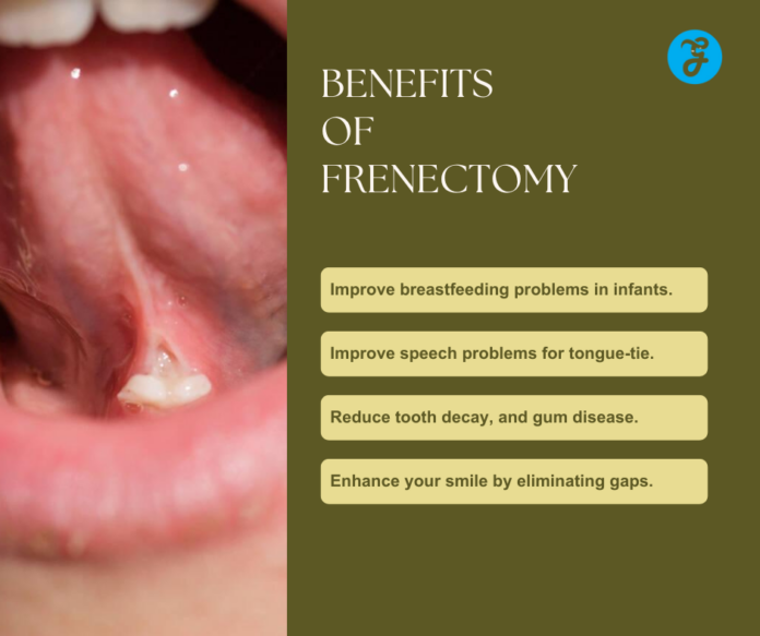 Tongue Tie Release Surgery Benefits And Critical Complications