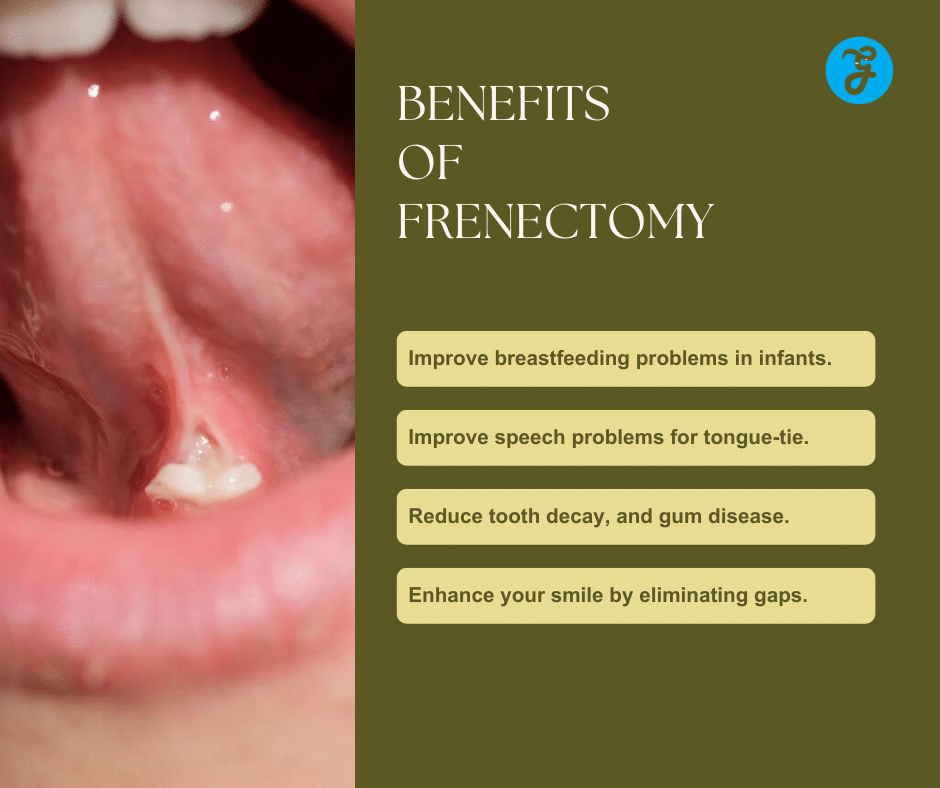 Benefits of Frenectomy