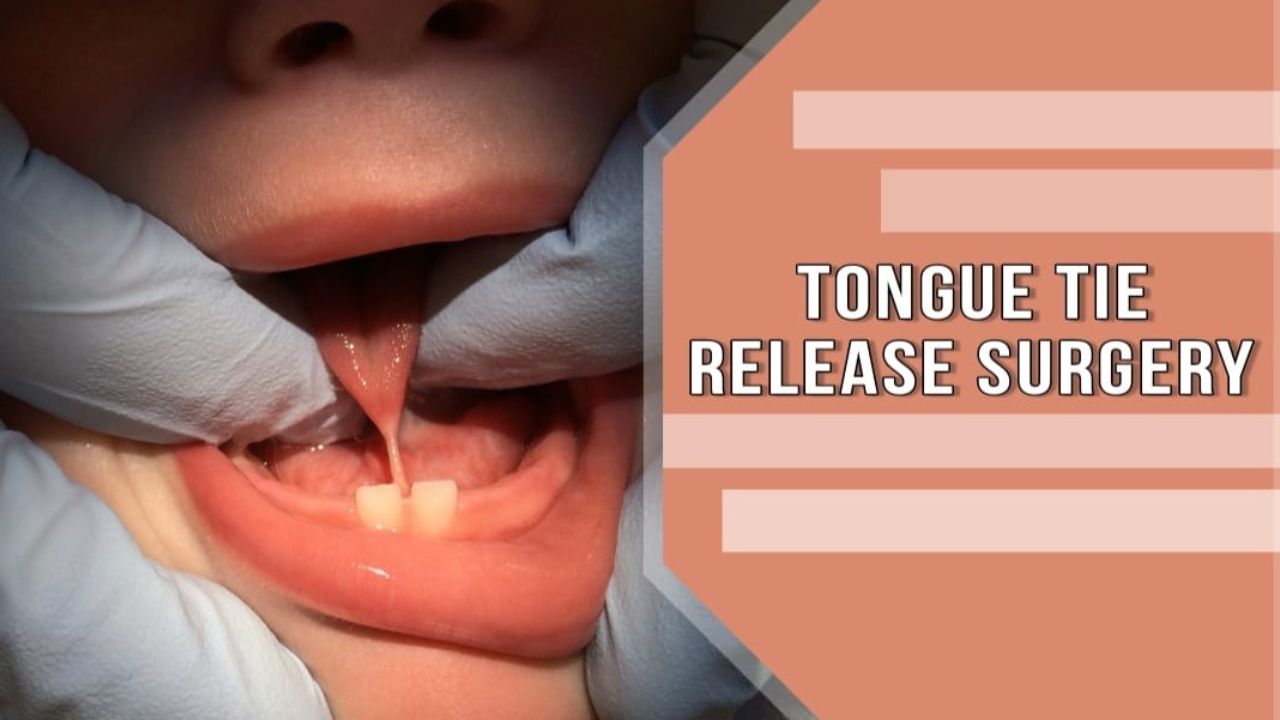 tongue tie release surgery