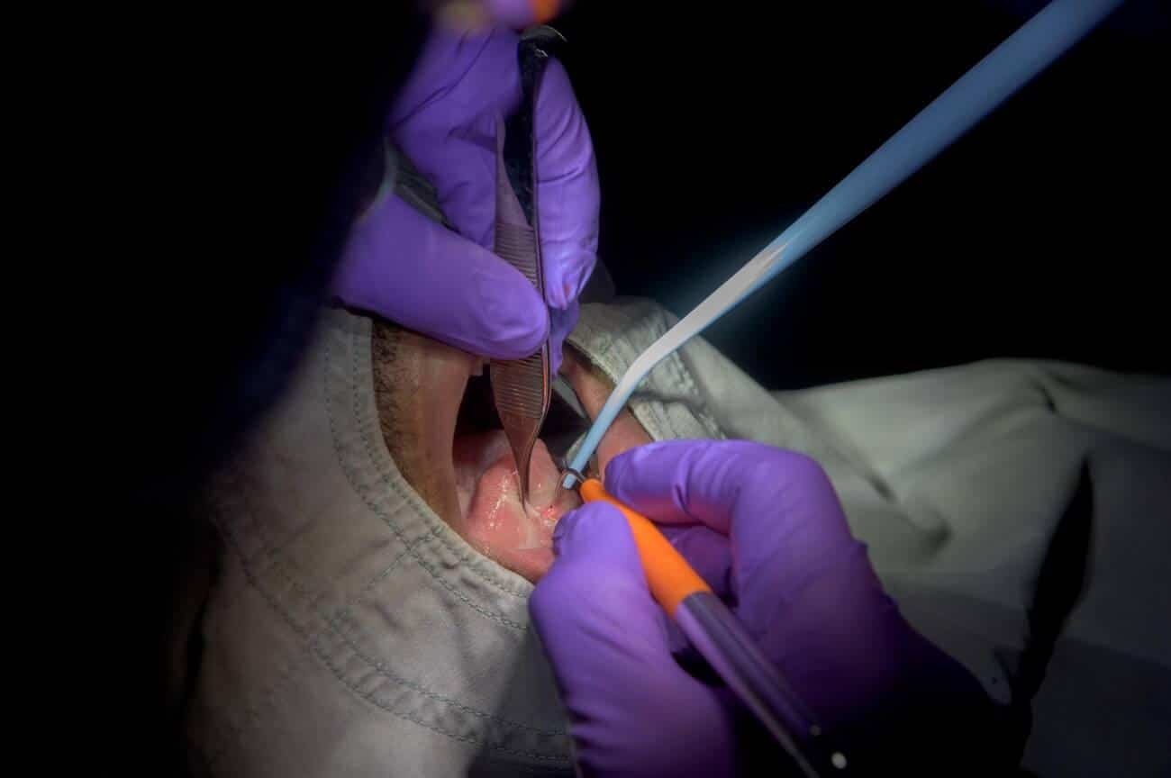 laser frenectomy