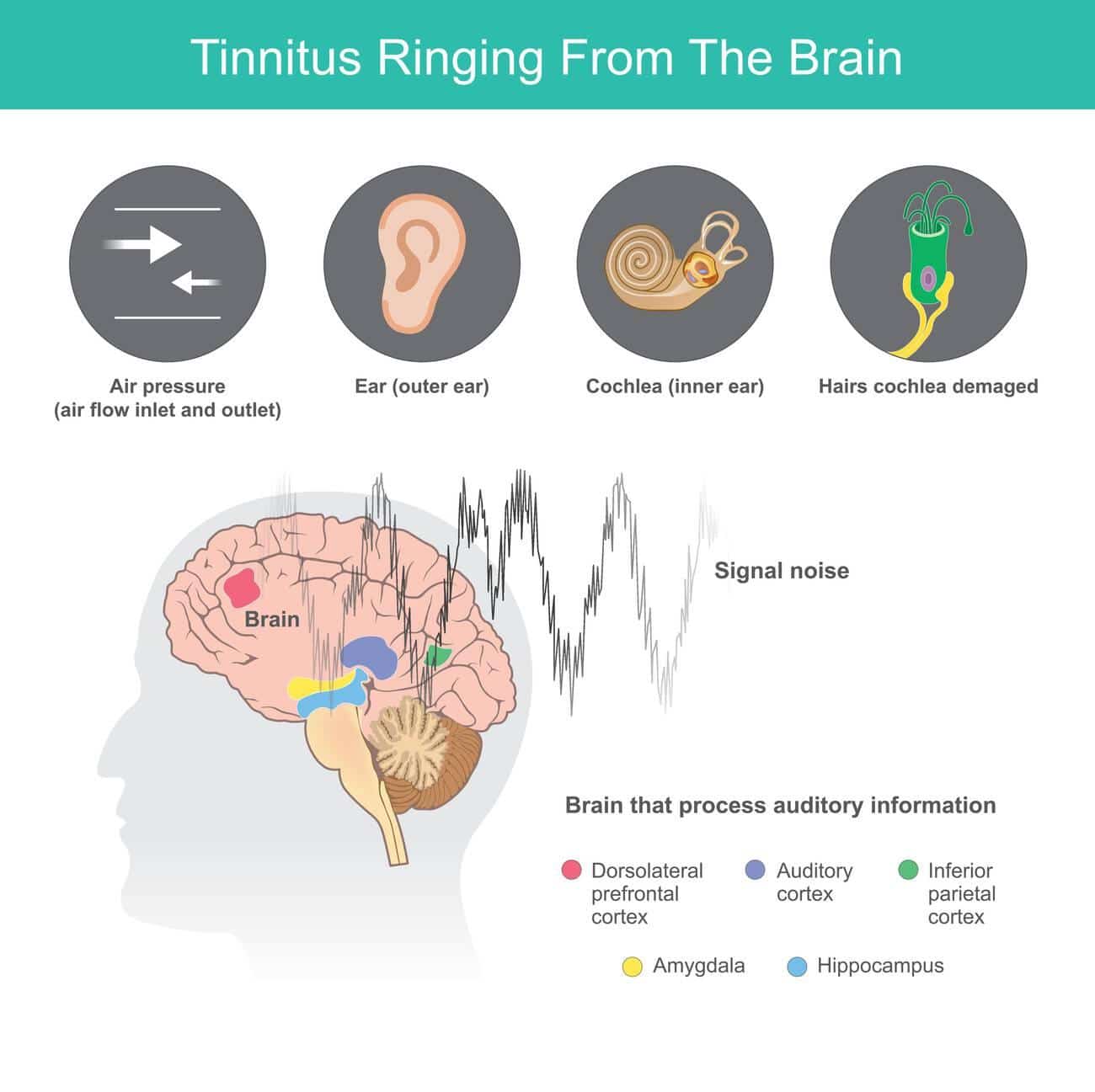 tinnitus ringing from brain