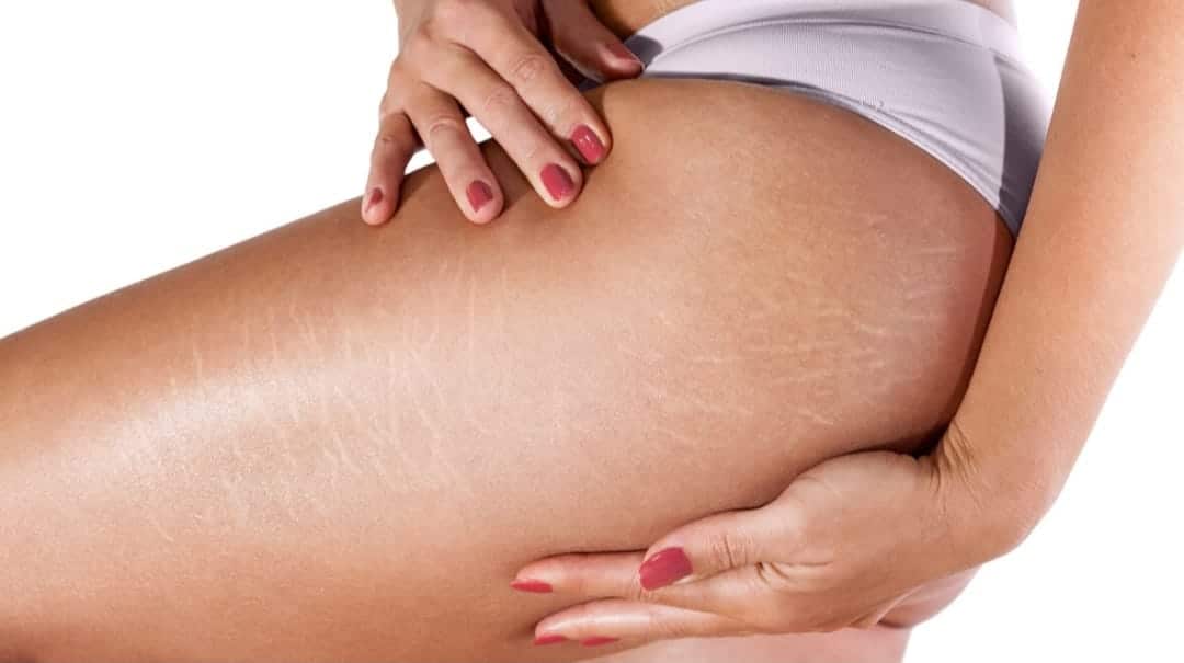 how to remove stretch marks on the body