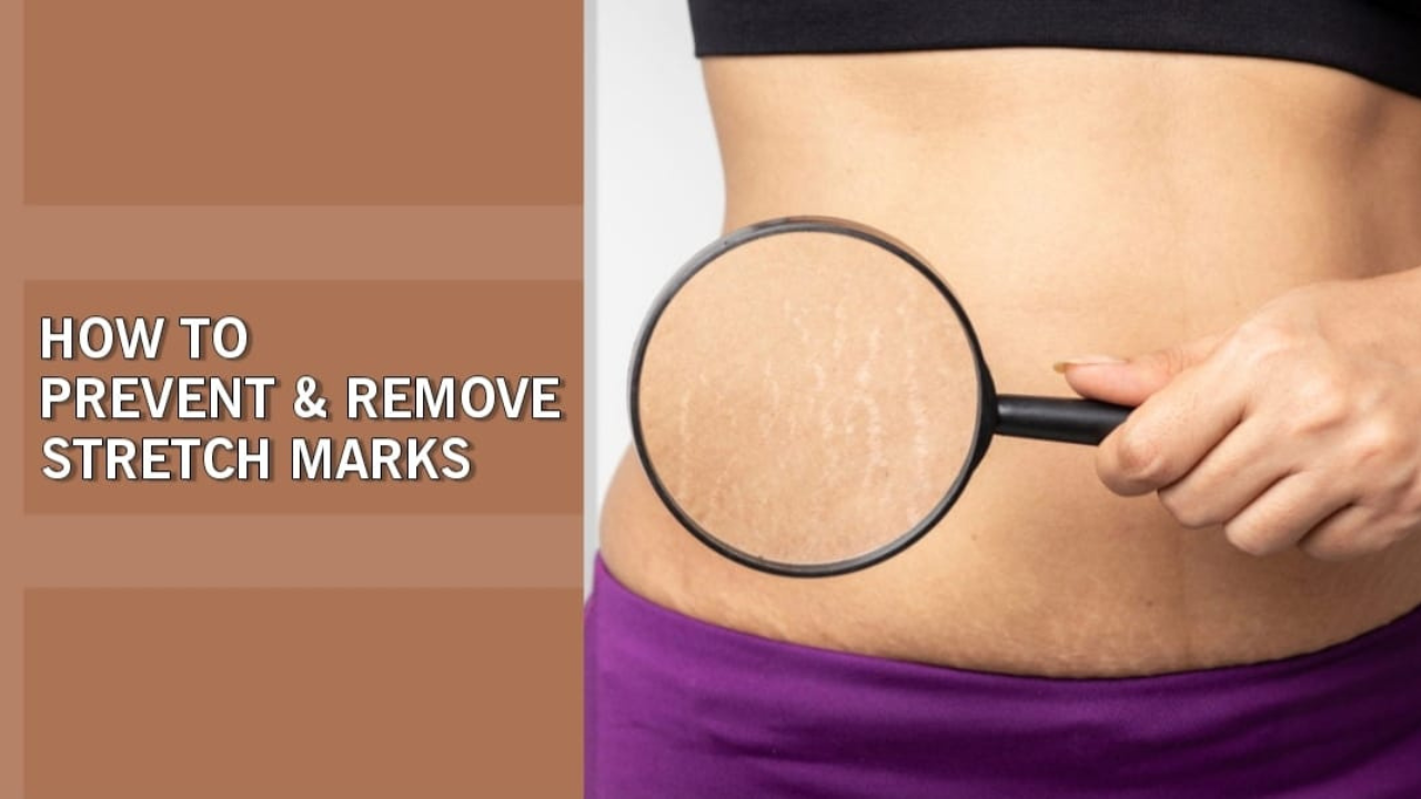 remove stretch marks on the body